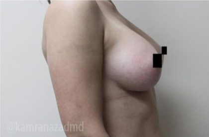Breast Augmentation Before & After Patient #2162
