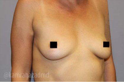 Breast Augmentation Before & After Patient #2162