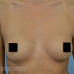 Breast Augmentation Before & After Patient #2160