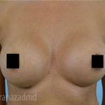 Breast Augmentation Before & After Patient #2160