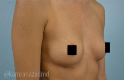 Breast Augmentation Before & After Patient #2160