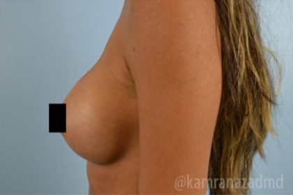 Breast Augmentation Before & After Patient #2160