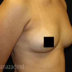 Breast Augmentation Before & After Patient #2120