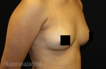 Breast Augmentation Before & After Patient #2120