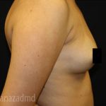Breast Augmentation Before & After Patient #2120