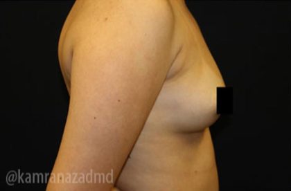 Breast Augmentation Before & After Patient #2120