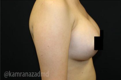 Breast Augmentation Before & After Patient #2120