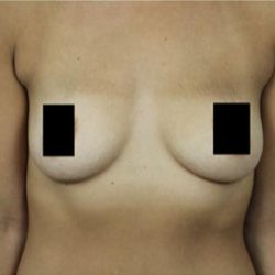 Breast Augmentation Before & After Patient #2122