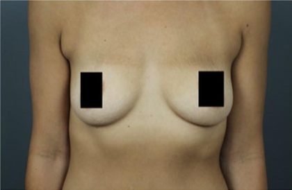 Breast Augmentation Before & After Patient #2122