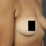 Breast Augmentation Before & After Patient #2122