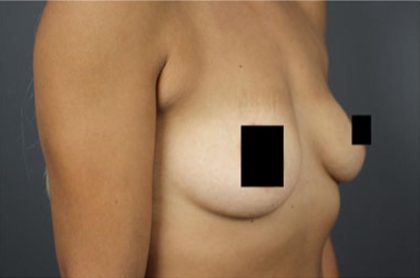 Breast Augmentation Before & After Patient #2122