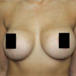 Breast Augmentation Before & After Patient #2122