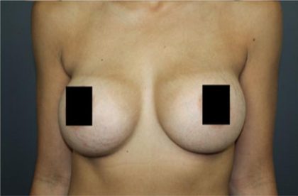 Breast Augmentation Before & After Patient #2122