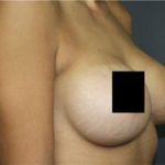 Breast Augmentation Before & After Patient #2122