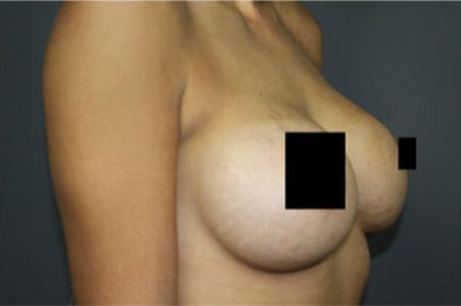 Breast Augmentation Before & After Patient #2122
