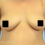 Breast Augmentation Before & After Patient #2123