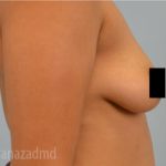 Breast Augmentation Before & After Patient #2123