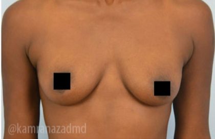 Breast Augmentation Before & After Patient #2124