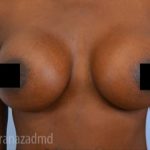 Breast Augmentation Before & After Patient #2124