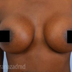 Breast Augmentation Before & After Patient #2124