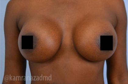 Breast Augmentation Before & After Patient #2124
