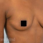 Breast Augmentation Before & After Patient #2124