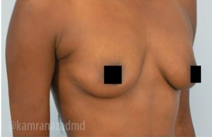 Breast Augmentation Before & After Patient #2124