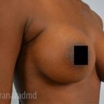 Breast Augmentation Before & After Patient #2124