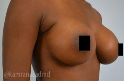 Breast Augmentation Before & After Patient #2124