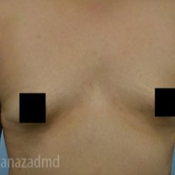 Breast Augmentation Before & After Patient #2125