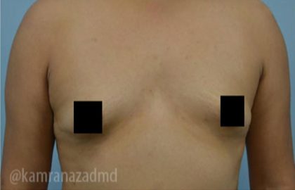 Breast Augmentation Before & After Patient #2125