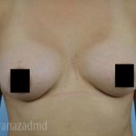 Breast Augmentation Before & After Patient #2125