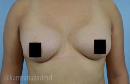 Breast Augmentation Before & After Patient #2125