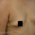 Breast Augmentation Before & After Patient #2125