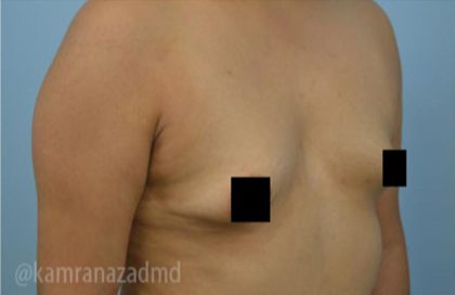 Breast Augmentation Before & After Patient #2125