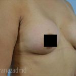 Breast Augmentation Before & After Patient #2125