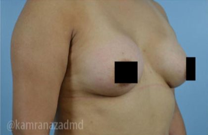 Breast Augmentation Before & After Patient #2125