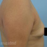 Breast Augmentation Before & After Patient #2125
