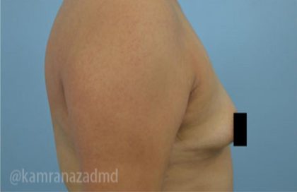 Breast Augmentation Before & After Patient #2125