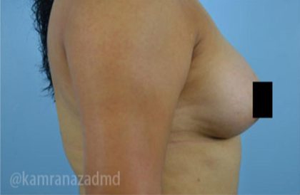 Breast Augmentation Before & After Patient #2125