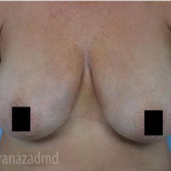 Breast Lift Before & After Patient #2288