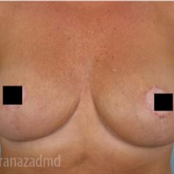 Breast Lift Before & After Patient #2288