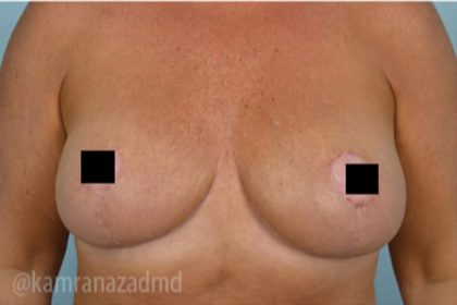Breast Lift Before & After Patient #2288