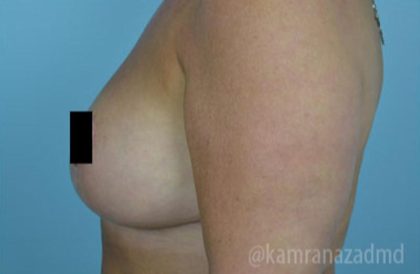 Breast Lift Before & After Patient #2288