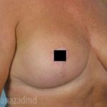 Breast Lift Before & After Patient #2288