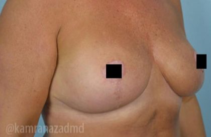Breast Lift Before & After Patient #2288