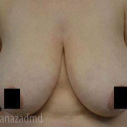 Breast Lift Before & After Patient #2289