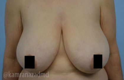 Breast Lift Before & After Patient #2289