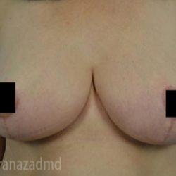 Breast Lift Before & After Patient #2289