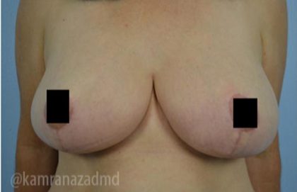 Breast Lift Before & After Patient #2289
